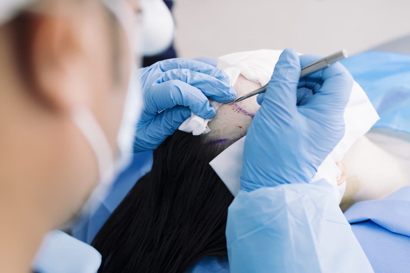 Hair transplant surgery process