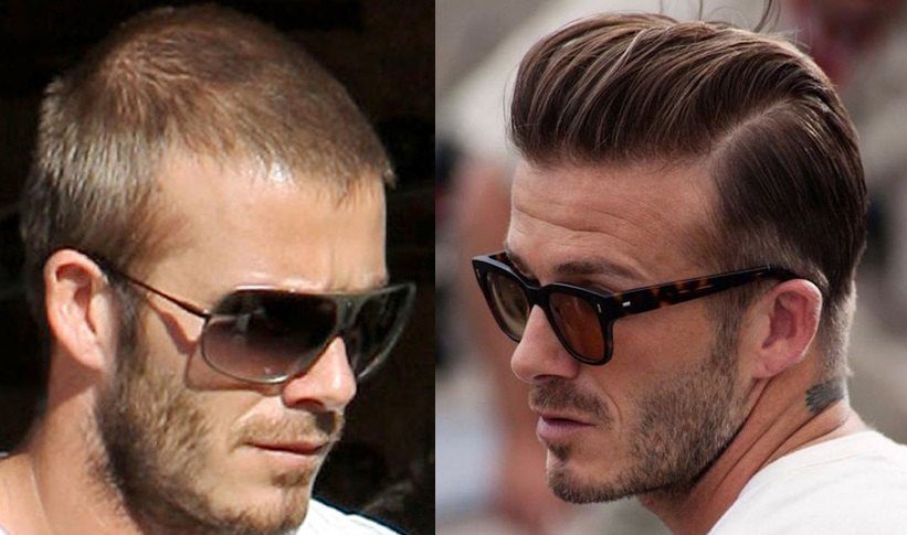 David Beckham - Hair Transplant or Hair Fibres? - The Hair Dr