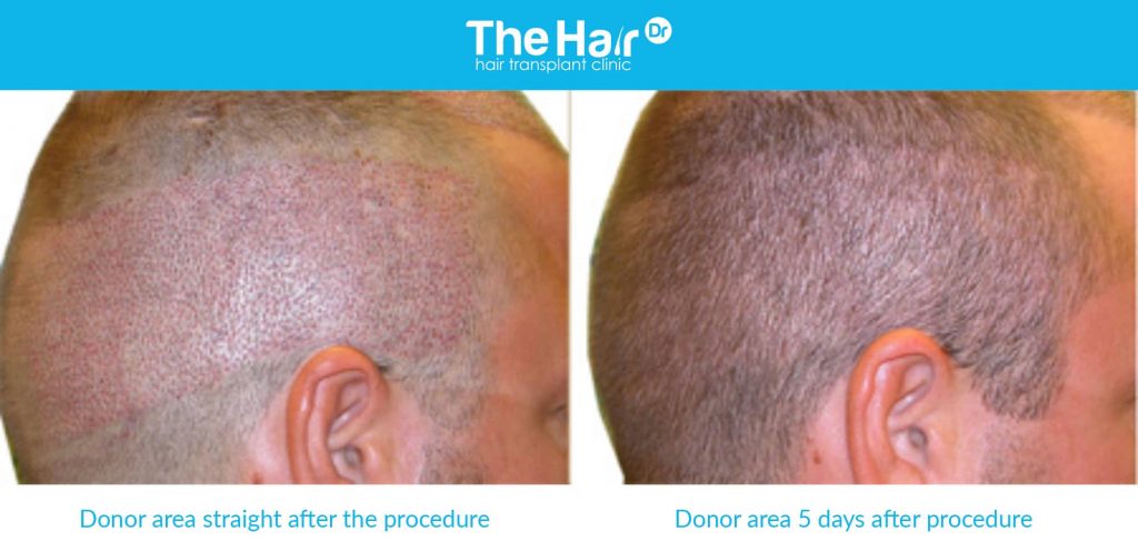 Example of a before and after of FUE treatment