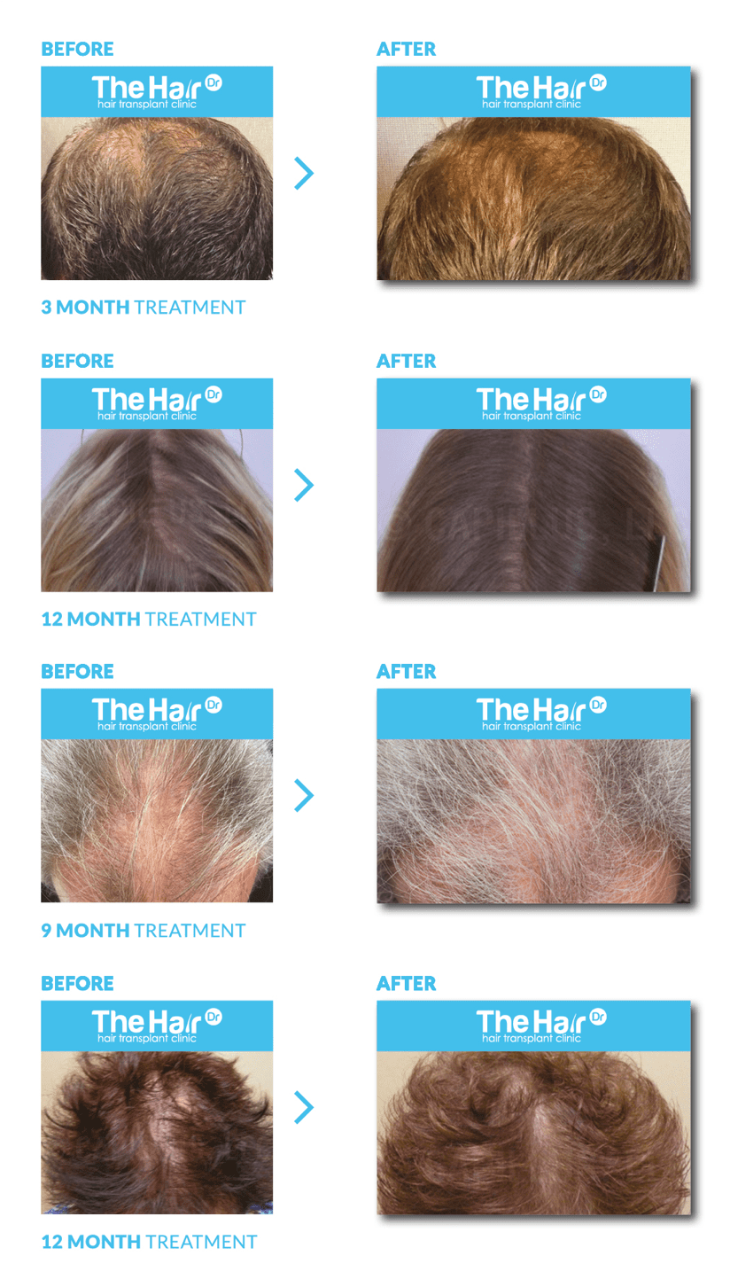Low Level Laser Therapy for Hair Loss? - The Hair Dr