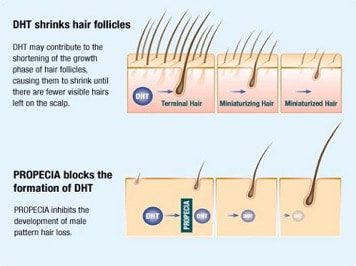 alternatives to hair transplant surgery