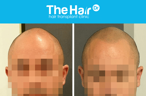 before and after hair transplant clinic