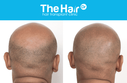 Hair Transplant or Scalp Micropigmentation (SMP)? - The Hair Dr