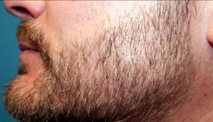 Beard transplants are on the rise - The Hair Dr