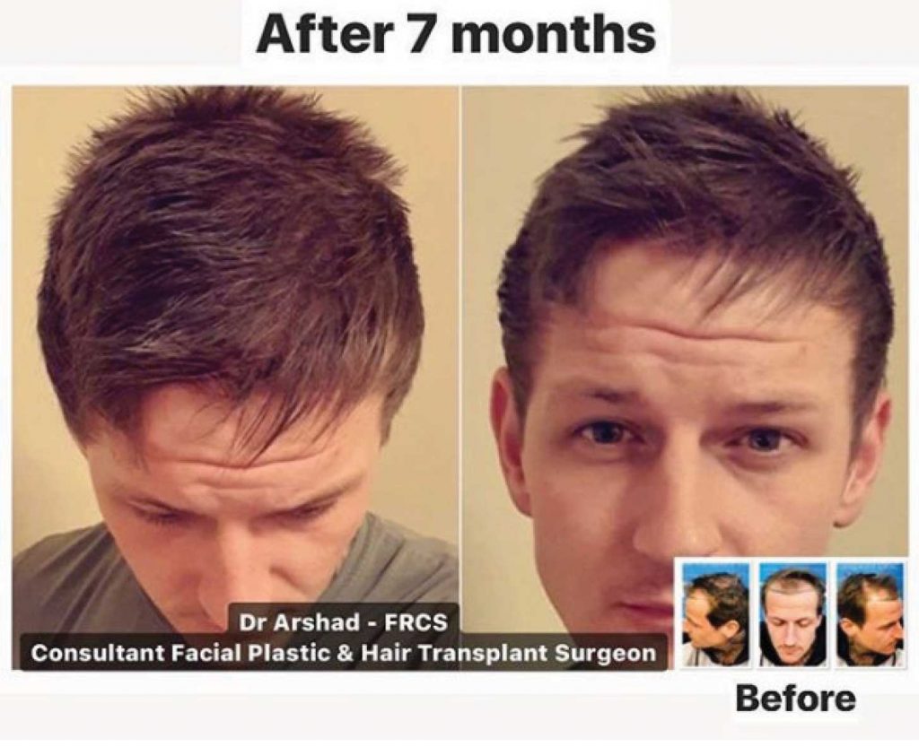 Before and 7 months after hair transplant procedure