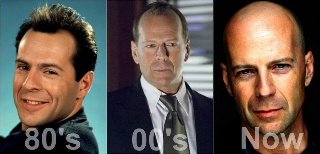 bruce willis hair loss