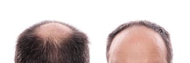 trichology and hair loss