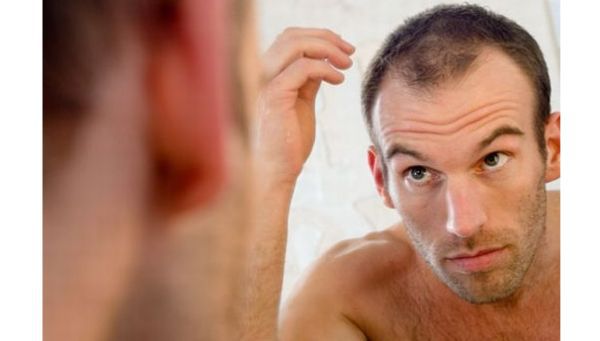 different types of hair loss