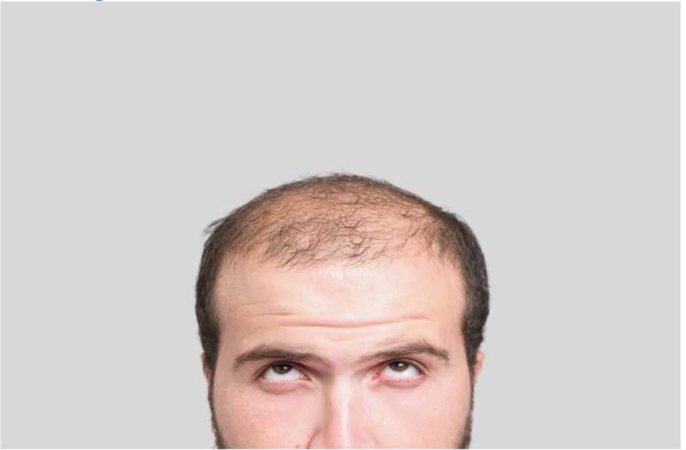 Differences between male and female hair loss - The Hair Dr