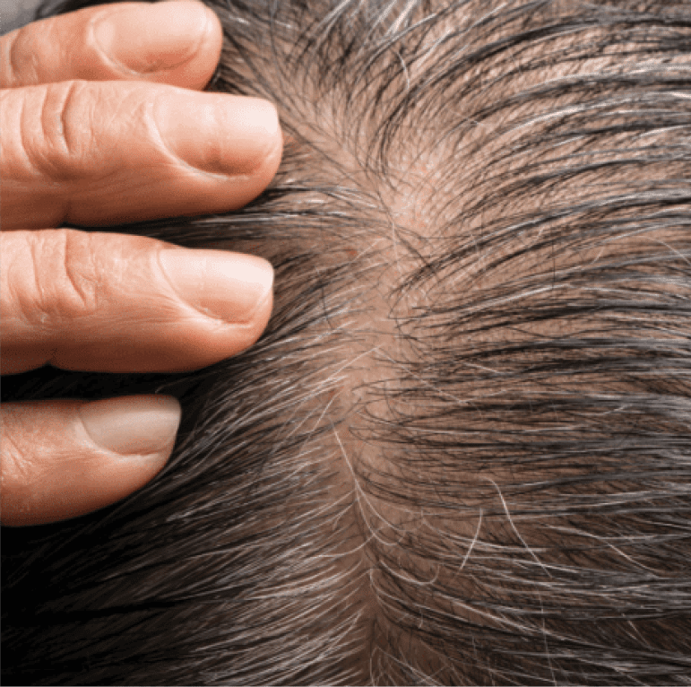 protect the scalp to avoid hair loss