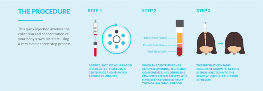 PRP Procedure