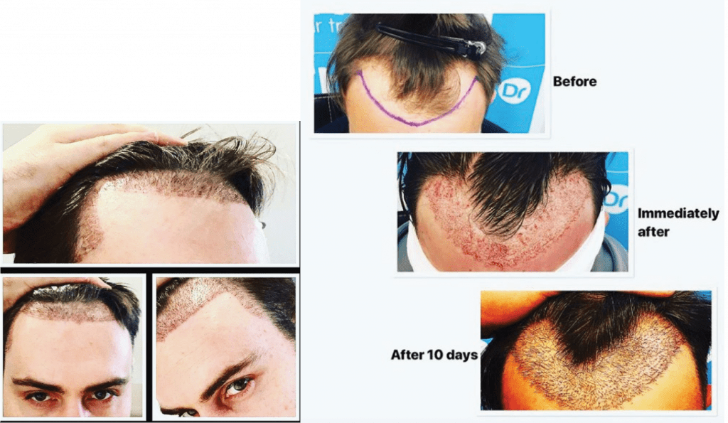 So why do crusts form after a hair transplant? - The Hair Dr