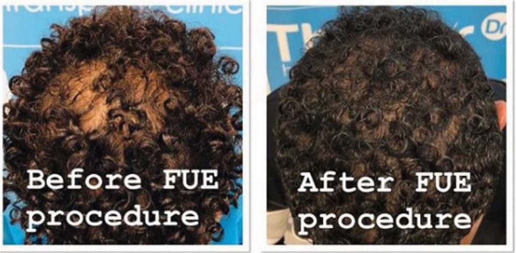 Before and after FUE procedure