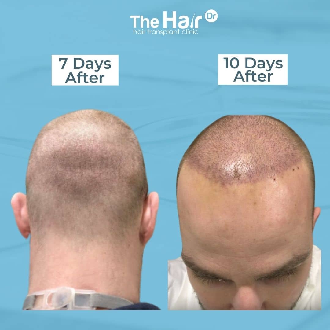 FUE Shock Loss After Hair Transplants - Northwestern Specialists