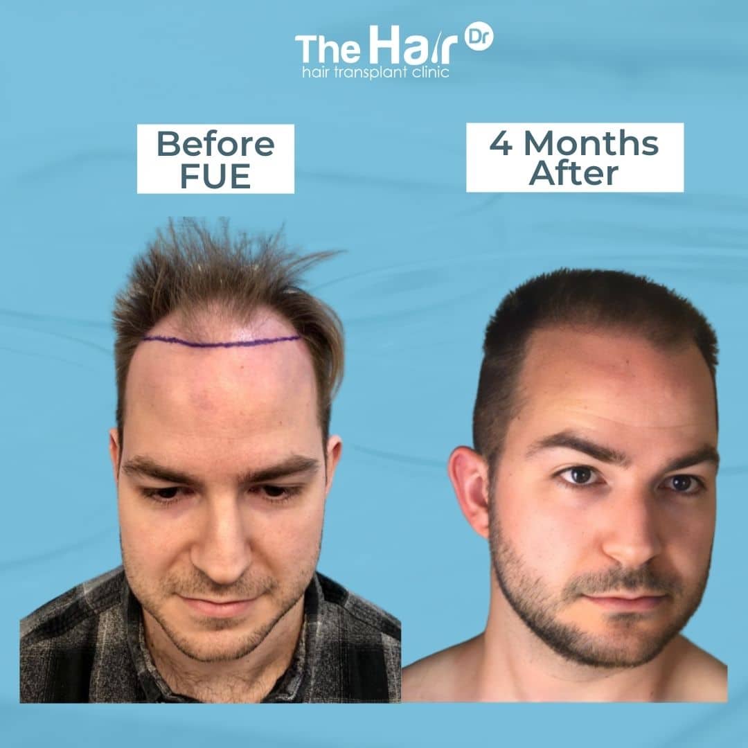 Hair Loss Treatment Beaconsfields | Hair Transplant Clinic