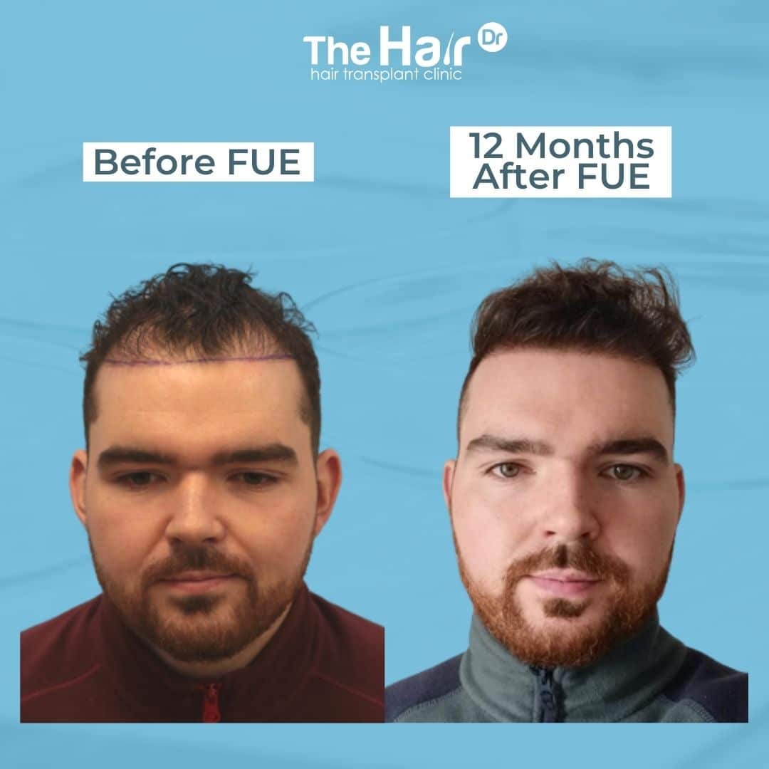 FUE hair transplant cost UK London: Receding hairline, hair thickening