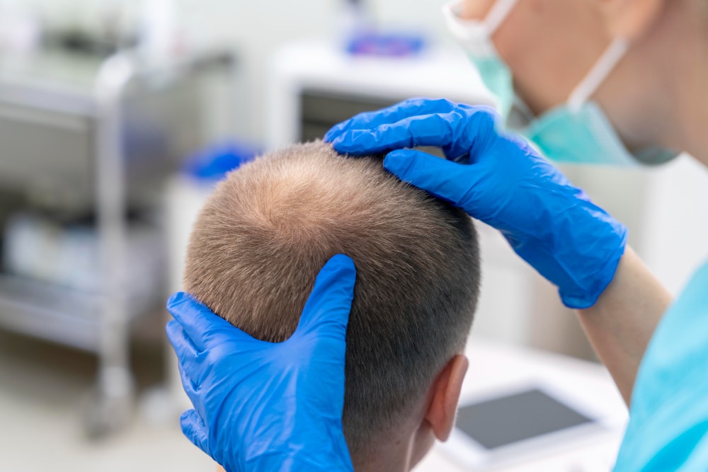 How Long Does A Hair Transplant last?