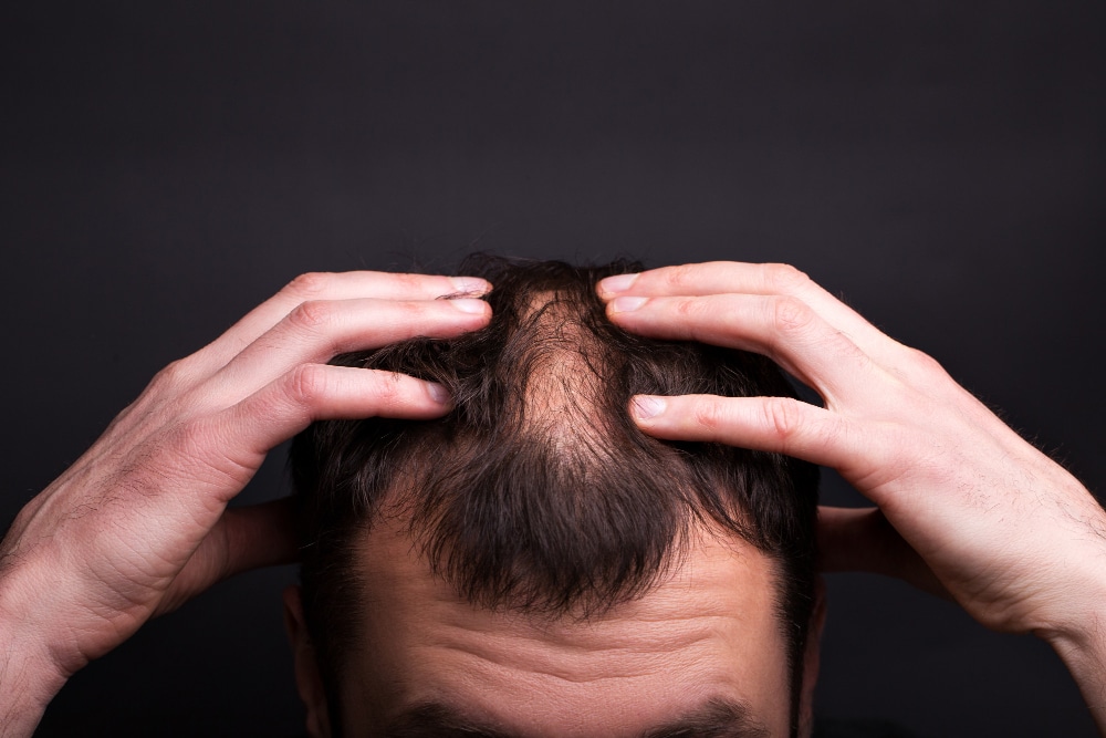 What is The Success Rate of A Hair Transplant?