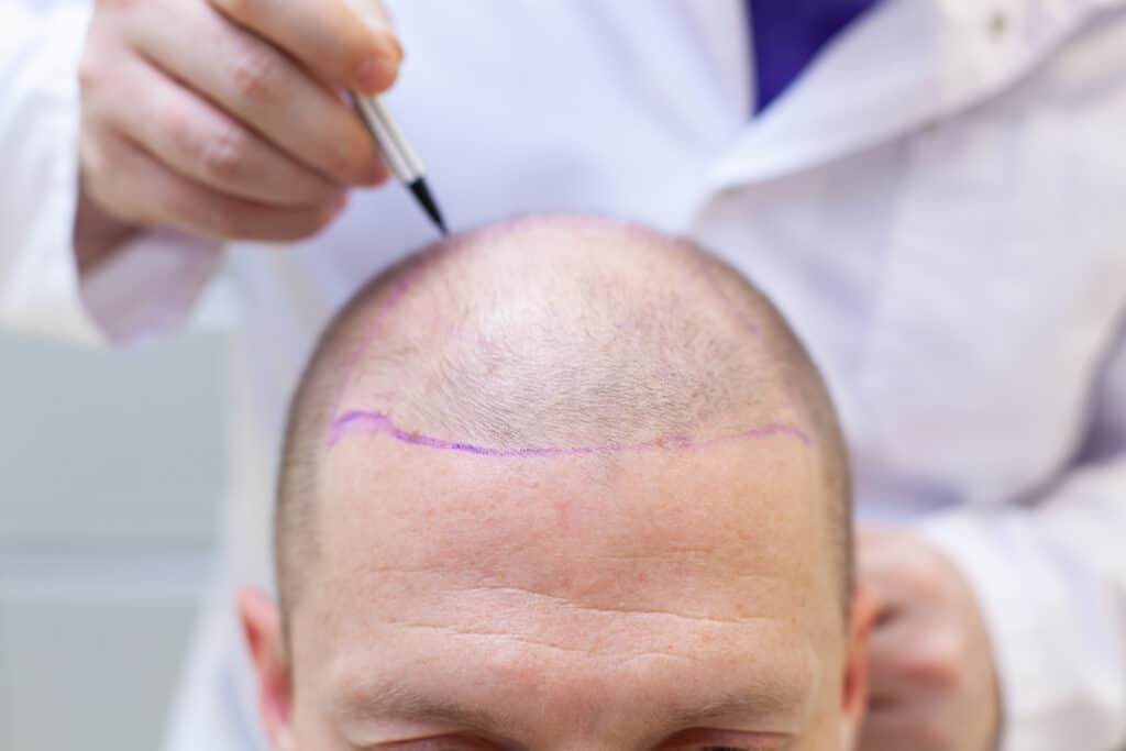 Do Hair transplants hurt?