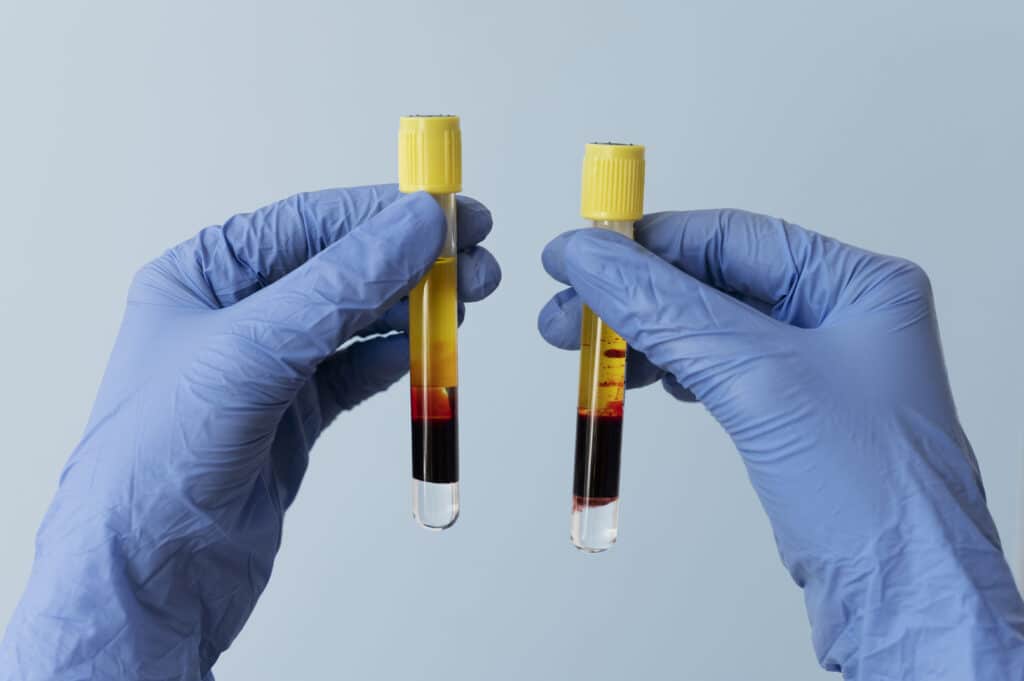 Does platelet-rich plasma work for hair growth?