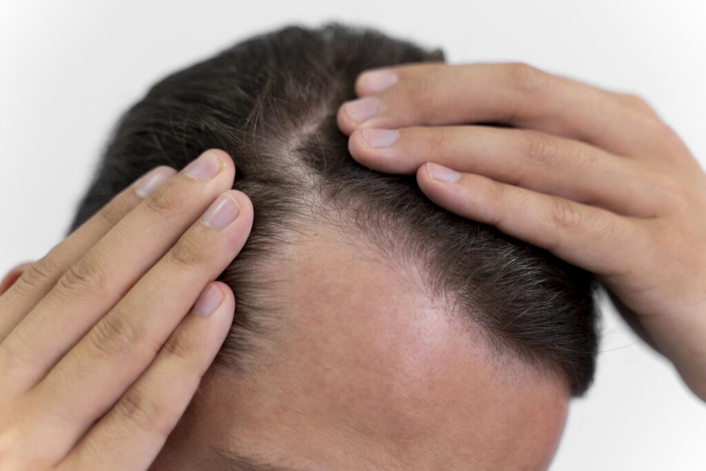 How to protect your scalp after a hair transplant