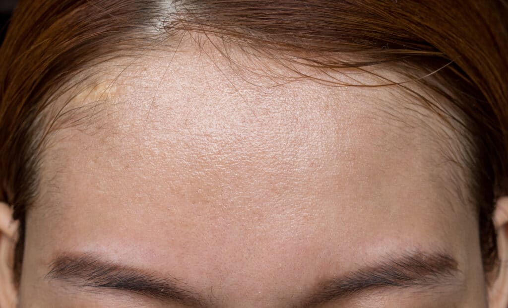 Hairline Lowering: Forehead Reduction Using Hair Transplant