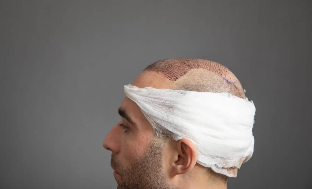 FUE Hair Transplants Explained: A Closer Look at the Technology Behind the Results