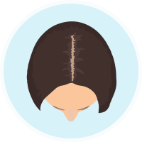 female partial balding head hair dr transplant