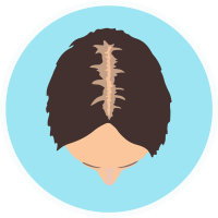 female balding hair parting dr transplant