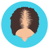 female balding hairline dr hair transplant