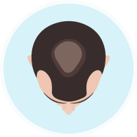 male partial balding head hair dr transplant