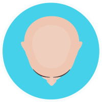 male full balding head hair dr transplant